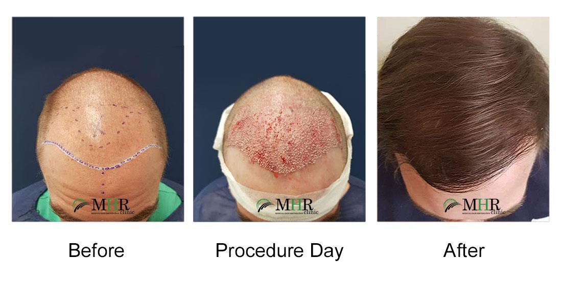 Fue Hair Transplant Before And After Results With All Hair Transplants